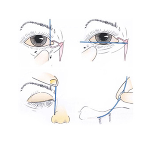 코 눈물관 더듬자검사(탕침법)